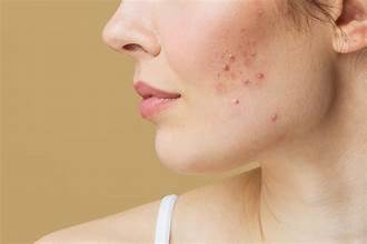 ACNE & BREAKOUTS