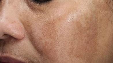 DARK SPOTS