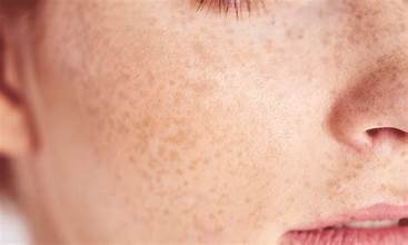 FRECKLES